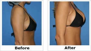Natural Breast Enlargement Cream for Larger Breasts